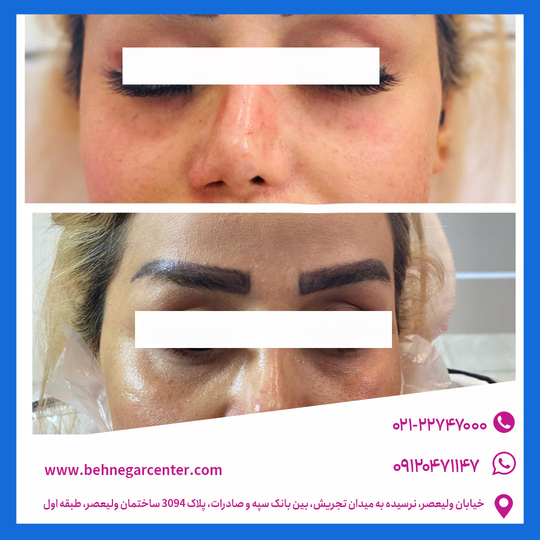 تزریق زیر چشم